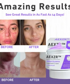 Crème de traitement de l'eczéma violet AEXZR™