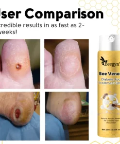 Spray de traitement des pieds diabétiques au venin d'abeille Beegyn™