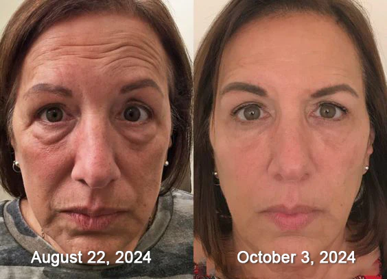 Furzero™ Botox Bee Venom Wrinkle Removal Serum Stick