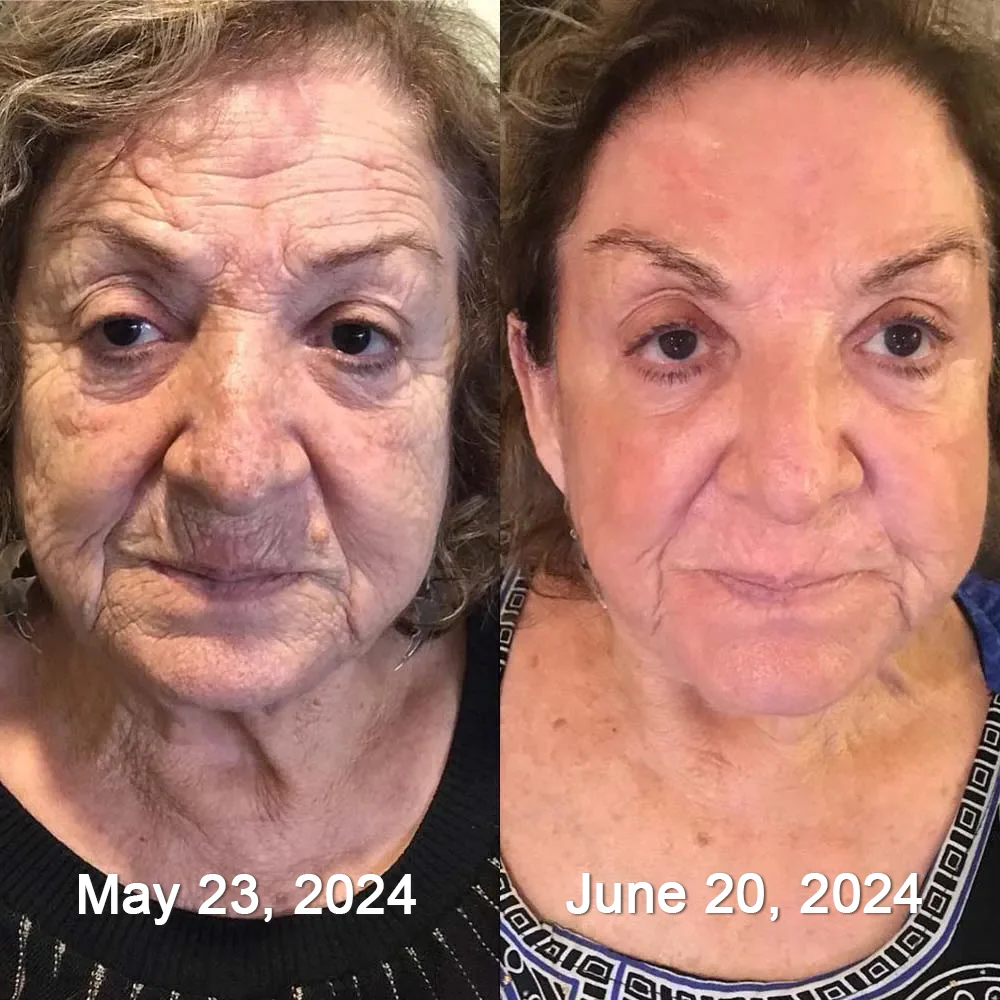 Furzero™ Botox Bee Venom Wrinkle Removal Serum Stick