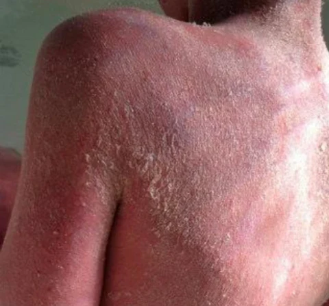 Winter Sale AEXZR™ Violet Eczema Treatment Cream