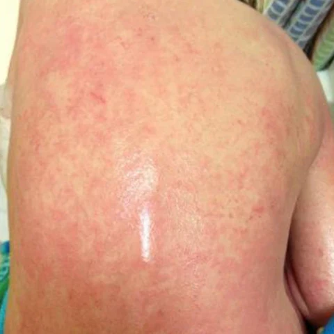 Winter Sale AEXZR™ Violet Eczema Treatment Cream