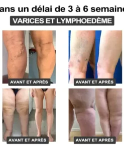 𝐂𝐙𝐓𝐈𝐂𝐋𝐄® 𝐁𝐫𝐚𝐜𝐞𝐥𝐞𝐭 𝐔𝐥𝐭𝐫𝐚𝐬𝐨𝐧𝐢𝐪𝐮𝐞 𝐝𝐞 𝐂𝐚𝐯𝐢𝐭𝐚𝐭𝐢𝐨𝐧 𝐞𝐭 𝐝𝐞 𝐃é𝐭𝐨𝐱𝐢𝐟𝐢𝐜𝐚𝐭𝐢𝐨𝐧