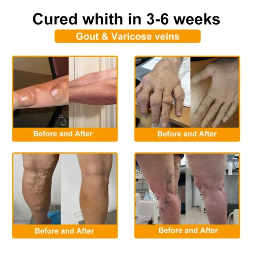 Botulinum Toxin & Bee Venom Ortopédiai Relief Krém 👩🏼‍⚕️ FDA által regisztrált | Amerikai Ortopédiai Szövetség (AOA) jóváhagyta
