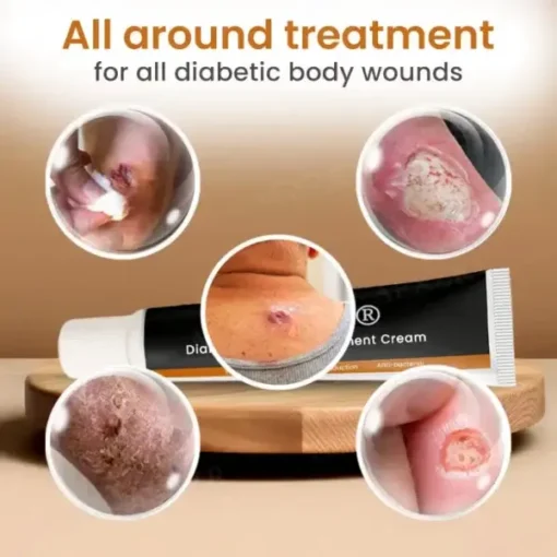 Cvreoz® Diabetic Wounds Treatment Cream
