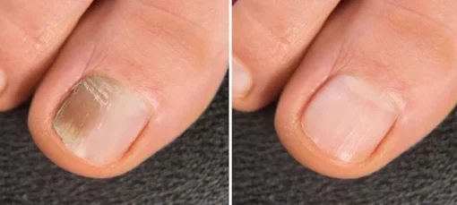LIMETOW® BeeVenom Anti-Fungal Nail Renewal Oil