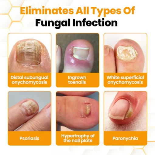LIMETOW® BeeVenom Anti-Fungal Nail Renewal Oil