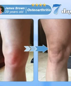 آفیشل اسٹور: AAOS نے EQVP® نینو مائیکرونیڈل جوائنٹ پیچ کی سفارش کی۔