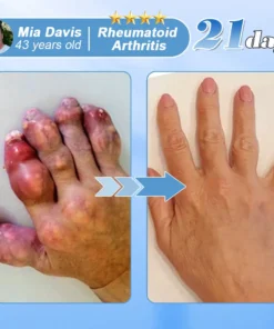 Hivatalos bolt: az AAOS által ajánlott EQVP® nano-mikrotűs ízületi tapasz