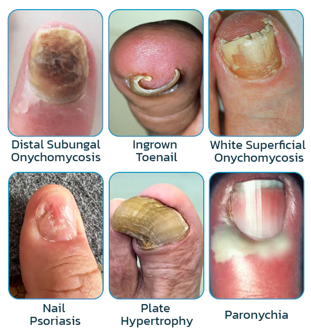 SEURICO™ Bee Venom Deep Repair Nail Essence | Powerful Antifungal & Nail Strengthening Solution