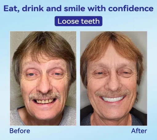 𝐁𝐢𝐤𝐞𝐧𝐝𝐚® 𝐏𝐫𝐞𝐦𝐢𝐮𝐦 𝐃𝐞𝐧𝐭𝐮𝐫𝐞