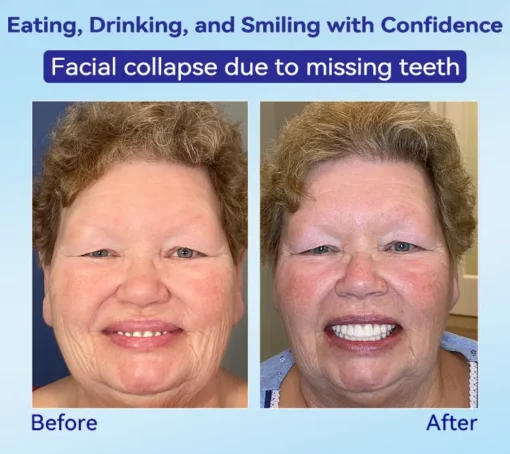 𝐁𝐢𝐤𝐞𝐧𝐝𝐚® 𝐏𝐫𝐞𝐦𝐢𝐮𝐦 𝐃𝐞𝐧𝐭𝐮𝐫𝐞