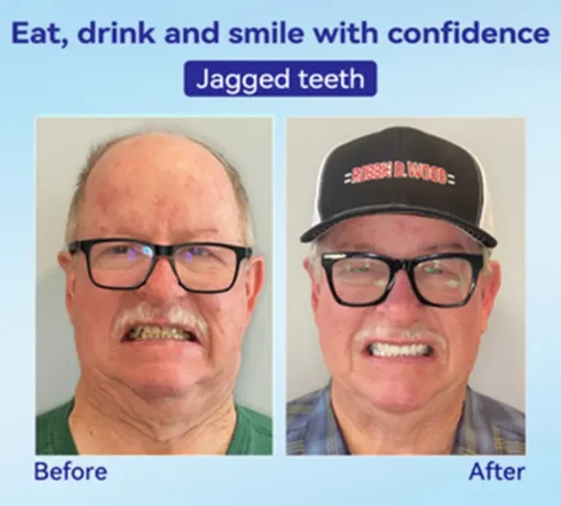 𝐁𝐢𝐤𝐞𝐧𝐝𝐚® 𝐏𝐫𝐞𝐦𝐢𝐮𝐦 𝐃𝐞𝐧𝐭𝐮𝐫𝐞