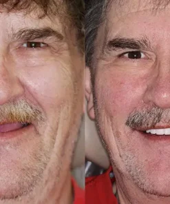 𝐁𝐢𝐤𝐞𝐧𝐝𝐚® Advanced Customized Full Denture Set