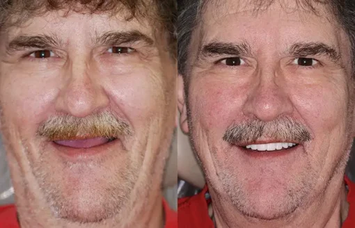 𝐁𝐢𝐤𝐞𝐧𝐝𝐚® Advanced Customized Full Denture Set
