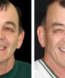 𝐁𝐢𝐤𝐞𝐧𝐝𝐚® Advanced Customized Full Denture Set