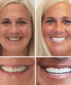 𝐁𝐢𝐤𝐞𝐧𝐝𝐚® Advanced Customized Full Denture Set
