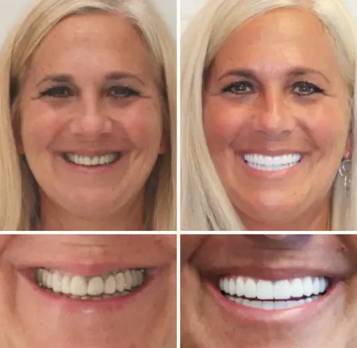 𝐁𝐢𝐤𝐞𝐧𝐝𝐚® Advanced Customized Full Denture Set