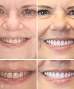 𝐁𝐢𝐤𝐞𝐧𝐝𝐚® Advanced Customized Full Denture Set