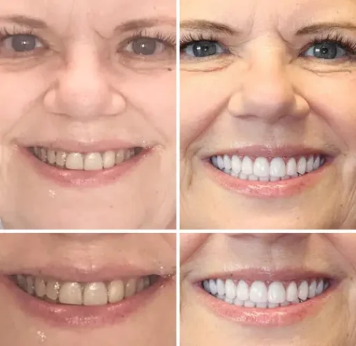 𝐁𝐢𝐤𝐞𝐧𝐝𝐚® Advanced Customized Full Denture Set