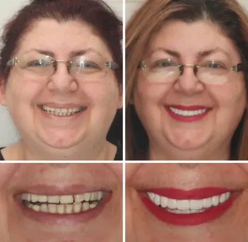 𝐁𝐢𝐤𝐞𝐧𝐝𝐚® Advanced Customized Full Denture Set