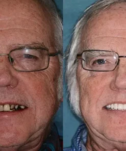 𝐁𝐢𝐤𝐞𝐧𝐝𝐚® Advanced Customized Full Denture Set