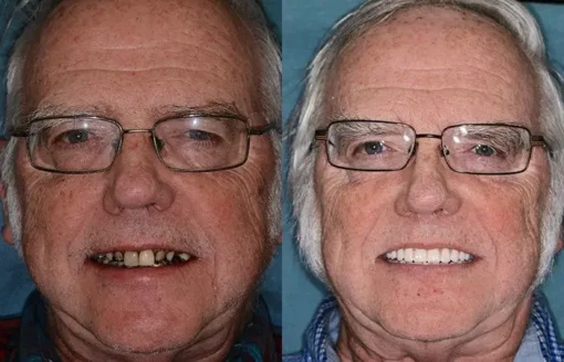 𝐁𝐢𝐤𝐞𝐧𝐝𝐚® Advanced Customized Full Denture Set