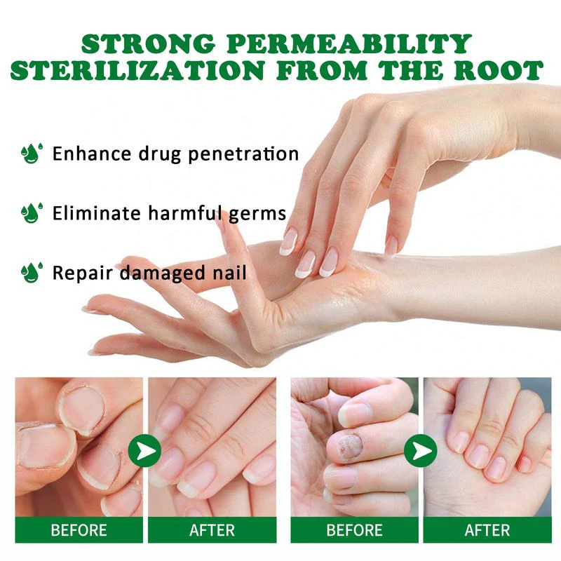 AQA™ - Ginger Nail Treatment Nail Support Nail Care