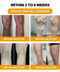 Hạt ngâm chân thảo dược Alisanda™ VenoDetox (Hạt massage chân thảo dược Alisanda™ Herbal VenoDetox)