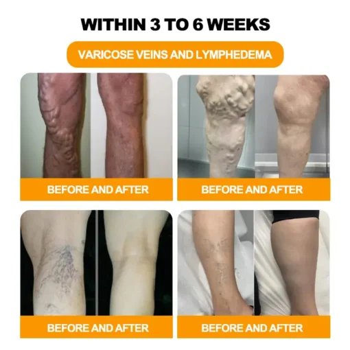 Hạt ngâm chân thảo dược Alisanda™ VenoDetox (Hạt massage chân thảo dược Alisanda™ Herbal VenoDetox)