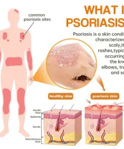 Semprotan Psoriasis LOVILDS™ PsoriaHeal untuk psoriasis