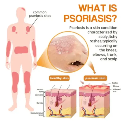 Semprotan Psoriasis LOVILDS™ PsoriaHeal untuk psoriasis
