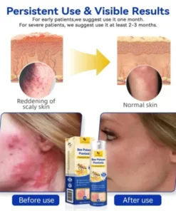 Semprotan Psoriasis LOVILDS™ PsoriaHeal untuk psoriasis