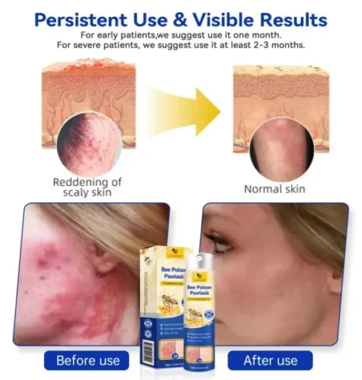 Semprotan Psoriasis LOVILDS™ PsoriaHeal untuk psoriasis