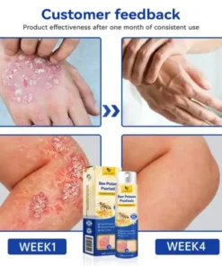 Semprotan Psoriasis LOVILDS™ PsoriaHeal untuk psoriasis