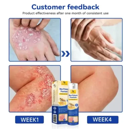 Semprotan Psoriasis LOVILDS™ PsoriaHeal untuk psoriasis