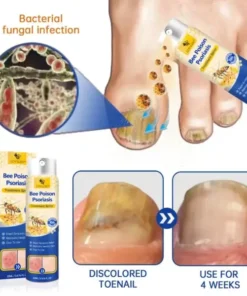Semprotan Psoriasis LOVILDS™ PsoriaHeal untuk psoriasis