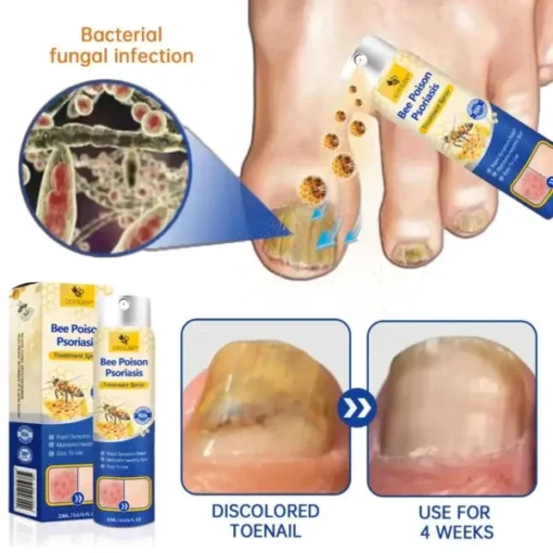 Semprotan Psoriasis LOVILDS™ PsoriaHeal untuk psoriasis