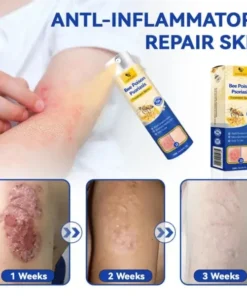 Semprotan Psoriasis LOVILDS™ PsoriaHeal untuk psoriasis