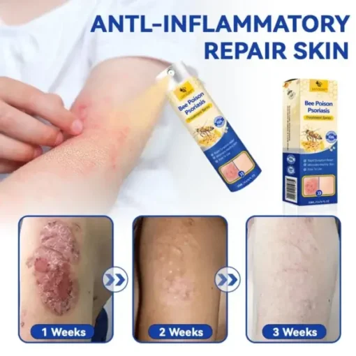 Semprotan Psoriasis LOVILDS™ PsoriaHeal untuk psoriasis