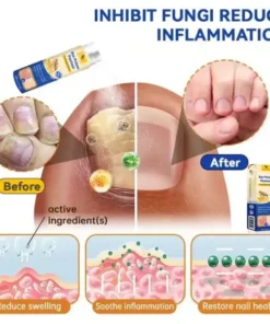 Semprotan Psoriasis LOVILDS™ PsoriaHeal untuk psoriasis