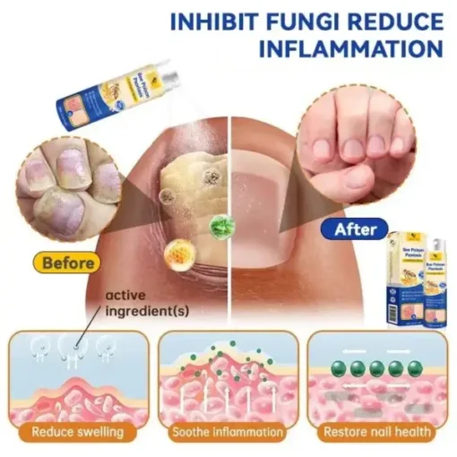 Semprotan Psoriasis LOVILDS™ PsoriaHeal untuk psoriasis