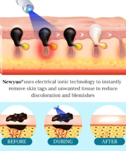 Newyuo® LumeSkin Mole and Wart Removal Laser Pen