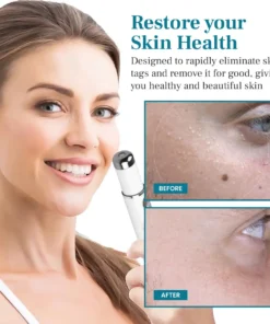 Newyuo® LumeSkin Mole and Wart Removal Laser Pen