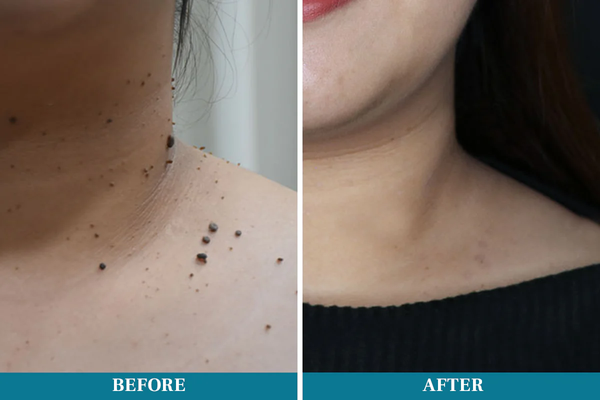 Newyuo® LumeSkin Mole and Wart Removal Laser Pen