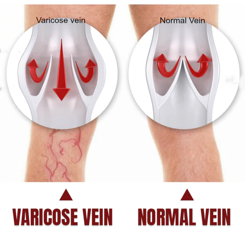 Timilk® Varicose Veins Healing Cream