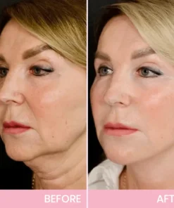 V-Face Lifting Invisible Adhesive Tape 10