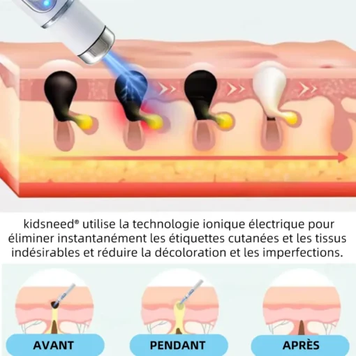 𝐤𝐢𝐝𝐬𝐧𝐞𝐞𝐝® 𝐆𝐫𝐚𝐢𝐧𝐬 𝐝𝐞 𝐛𝐞𝐚𝐮𝐭é 𝐞𝐭 𝐯𝐞𝐫𝐫𝐮𝐞𝐬 𝐧𝐨𝐧 𝐢𝐧𝐯𝐚𝐬𝐢𝐟𝐬 𝐒𝐭𝐲𝐥𝐨 𝐥𝐚𝐬𝐞𝐫 𝐝'é𝐥𝐢𝐦𝐢𝐧𝐚𝐭𝐢𝐨𝐧