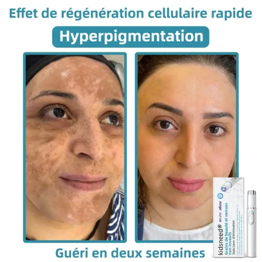 𝐤𝐢𝐝𝐬𝐧𝐞𝐞𝐝® 𝐆𝐫𝐚𝐢𝐧𝐬 𝐝𝐞 𝐛𝐞𝐚𝐮𝐭é 𝐞𝐭 𝐯𝐞𝐫𝐫𝐮𝐞𝐬 𝐧𝐨𝐧 𝐢𝐧𝐯𝐚𝐬𝐢𝐟𝐬 𝐒𝐭𝐲𝐥𝐨 𝐥𝐚𝐬𝐞𝐫 𝐝'é𝐥𝐢𝐦𝐢𝐧𝐚𝐭𝐢𝐨𝐧