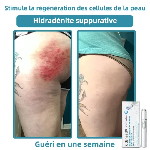 𝐤𝐢𝐝𝐬𝐧𝐞𝐞𝐝® 𝐆𝐫𝐚𝐢𝐧𝐬 𝐝𝐞 𝐛𝐞𝐚𝐮𝐭é 𝐞𝐭 𝐯𝐞𝐫𝐫𝐮𝐞𝐬 𝐧𝐨𝐧 𝐢𝐧𝐯𝐚𝐬𝐢𝐟𝐬 𝐒𝐭𝐲𝐥𝐨 𝐥𝐚𝐬𝐞𝐫 𝐝'é𝐥𝐢𝐦𝐢𝐧𝐚𝐭𝐢𝐨𝐧